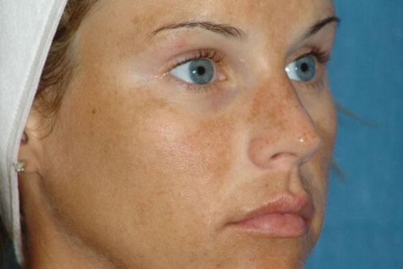 age spots as an indication for fractional rejuvenation