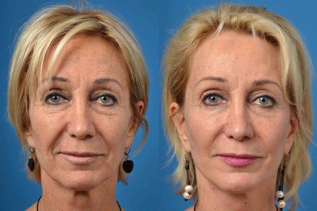 Before and after laser skin resurfacing