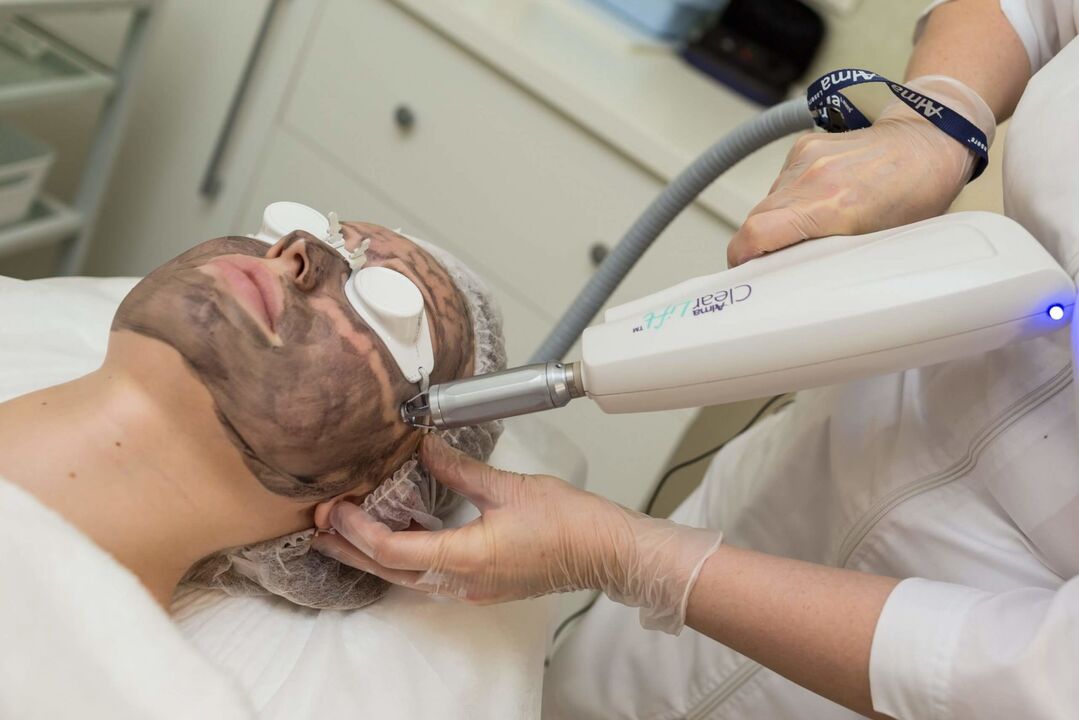 Facial laser peeling session