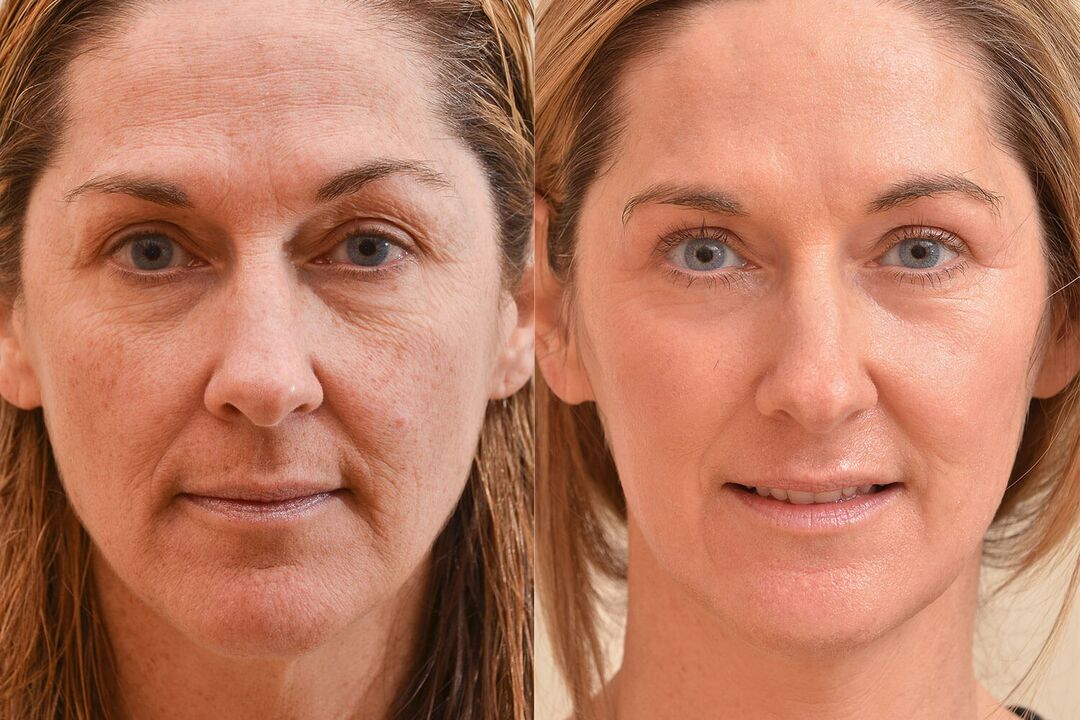 The result of laser skin rejuvenation