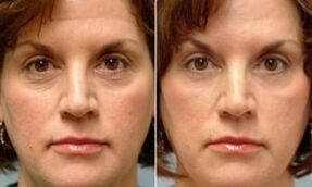 before and after fractional rejuvenation procedure