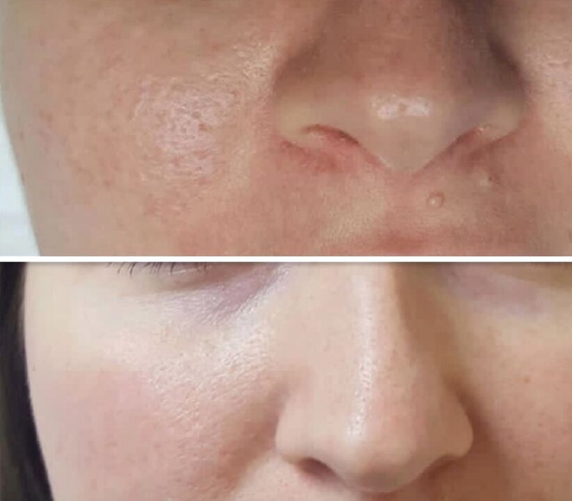 The result of fractional rejuvenation - facial skin before and after the procedure